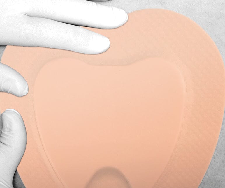 Advazorb Sacral Advancis Medical 